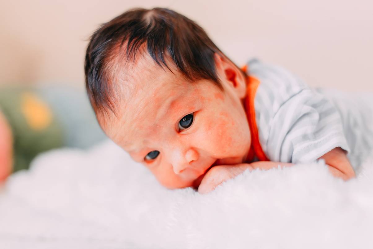 أسباب الطفح الجلدي عند الطفل الرضيع 55875