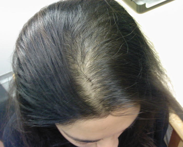 تساقط الشعر الوراثي