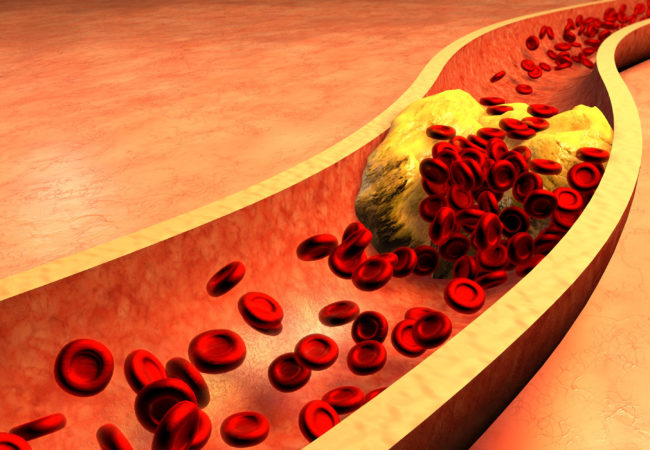الكولسترول المرتفع يزيد من خطر الإصابة بنوبة قلبية