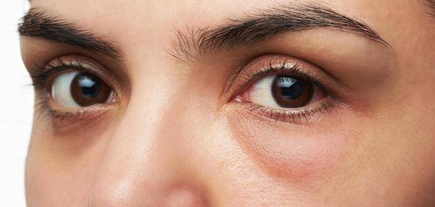 انتفاخ العيون يشي بنقص الفيتامينات في الجسم