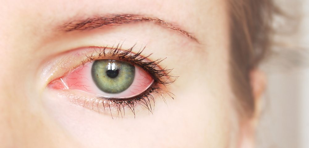 فيروس كورونا قد يسبب التهاب ملتحمة العين