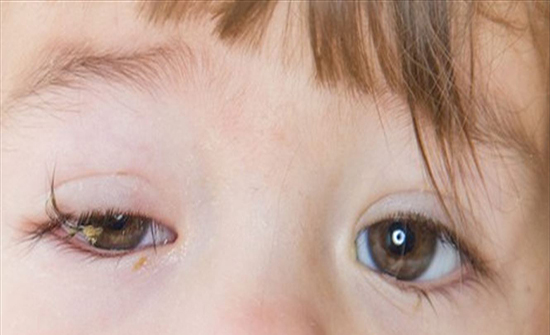 للاطفال احمرار العين احمرار العين