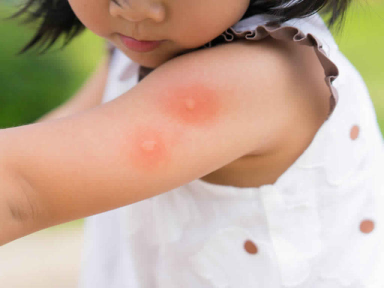 هيأ إرنست شاكلتون فضيحة علاج حساسية الجلد للاطفال f1inspiration com