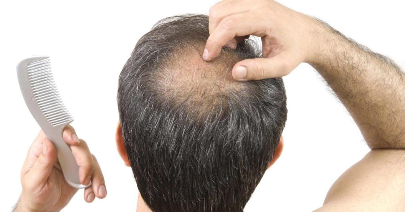 استشاري جلدية يوضح أسباب فشل عمليات زراعة الشعر | مجلة سيدتي