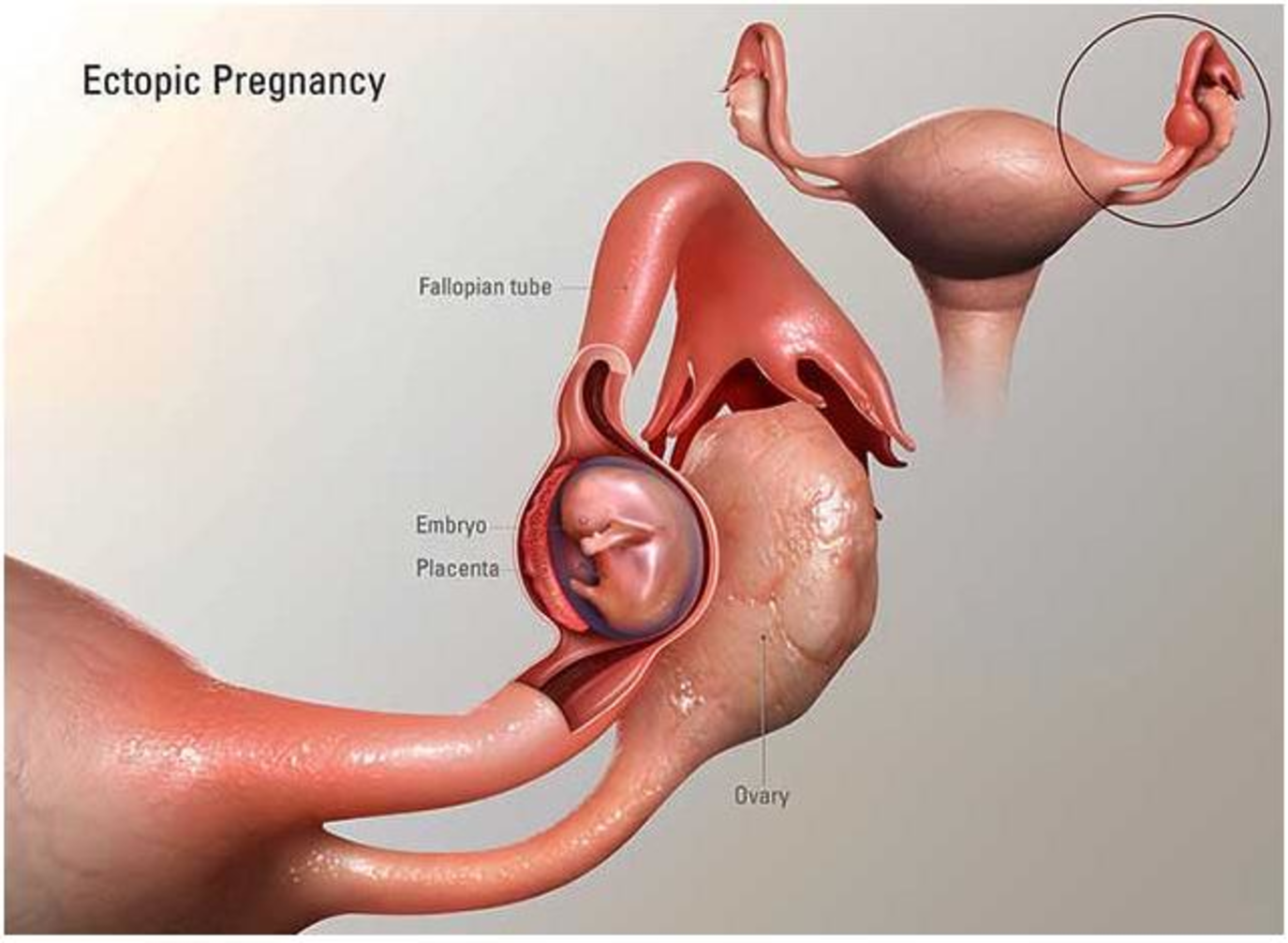 الحمل خارج الرحم أسبابه وطرق الوقاية- صحتك