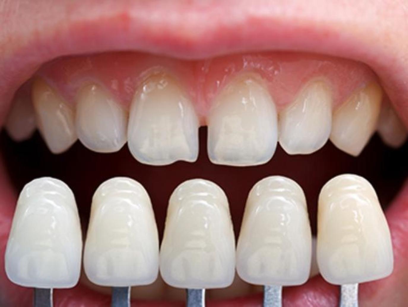 طبيب أسنان: احذروا ابتسامة هوليوود! | مجلة سيدتي