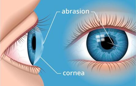 دراسة: تلف الأعصاب في قرنية العين علامة على الإصابة بكورونا طويل الأمد
