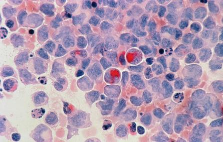 صورة خلايا سرطانية
