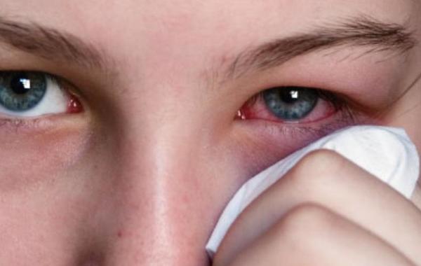 استشاري عيون: نسبة إصابة الأطفال بحساسية العين 10% والنساء أكثر عرضة لجفاف العين