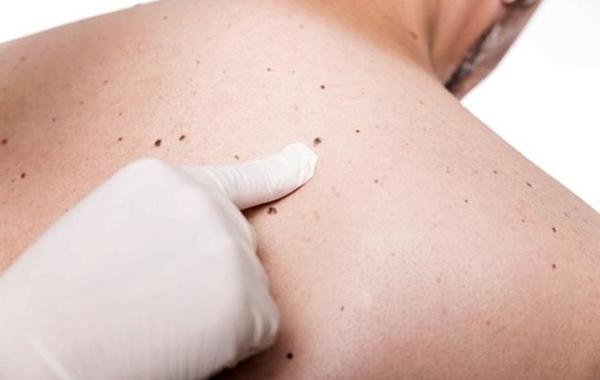 دراسة تؤكد ارتفاع الوفيات الناجمة عن سرطان الجلد في صفوف الرجال
