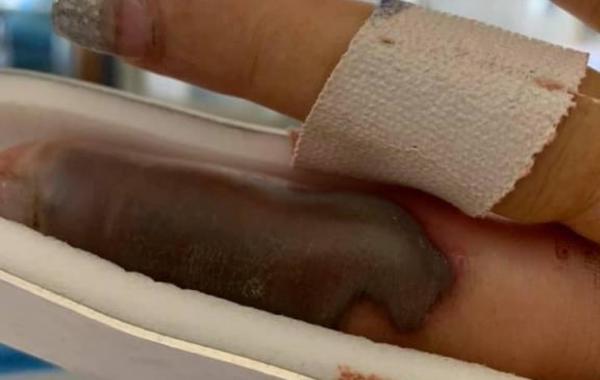 بالصور: امرأة أسترالية كادت تفقد إصبعها بعد زيارتها لصالون تجميل