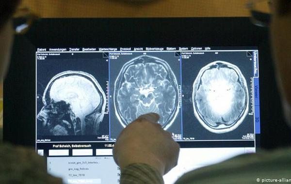 دراسة تحذر من إمكانية حدوث مشاكل دماغية لمصابي كورونا