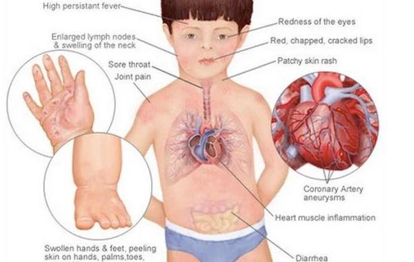 كاواساكي: مرض يظهر في الأطفال له علاقة بفيروس كورونا