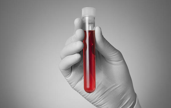 علاج فقر الدم المنجلي بالخلايا الجذعية والعلاج الوراثي