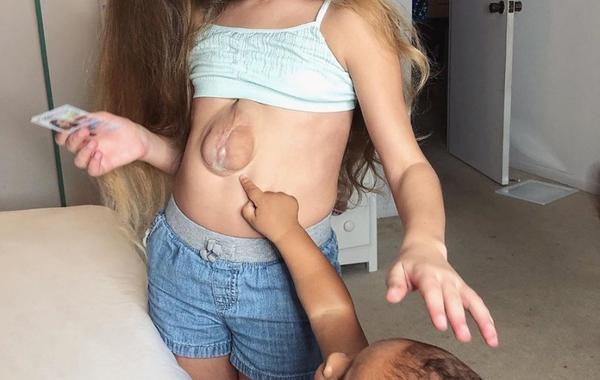 تحدت الأطباء.. طفلة تعيش بقلبها خارج صدرها منذ ولادتها 