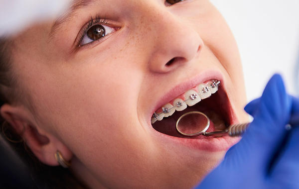 متى يحتاج طفلي إلى تقويم الأسنان؟ وما العمر المناسب؟