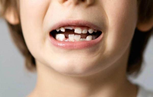 الأسنان اللبنية تبدأ بالسقوط مع سن المدرسة