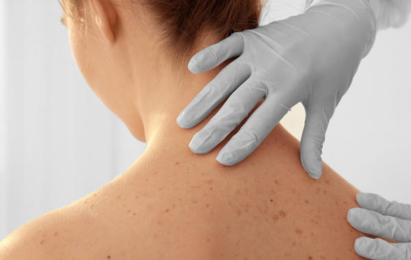 سرطان الجلد: غالباً ما يتم إغفال تطبيق الحماية على هذه المنطقة