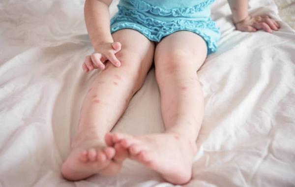 صورة لطفل يعاني من حساسية الجلد